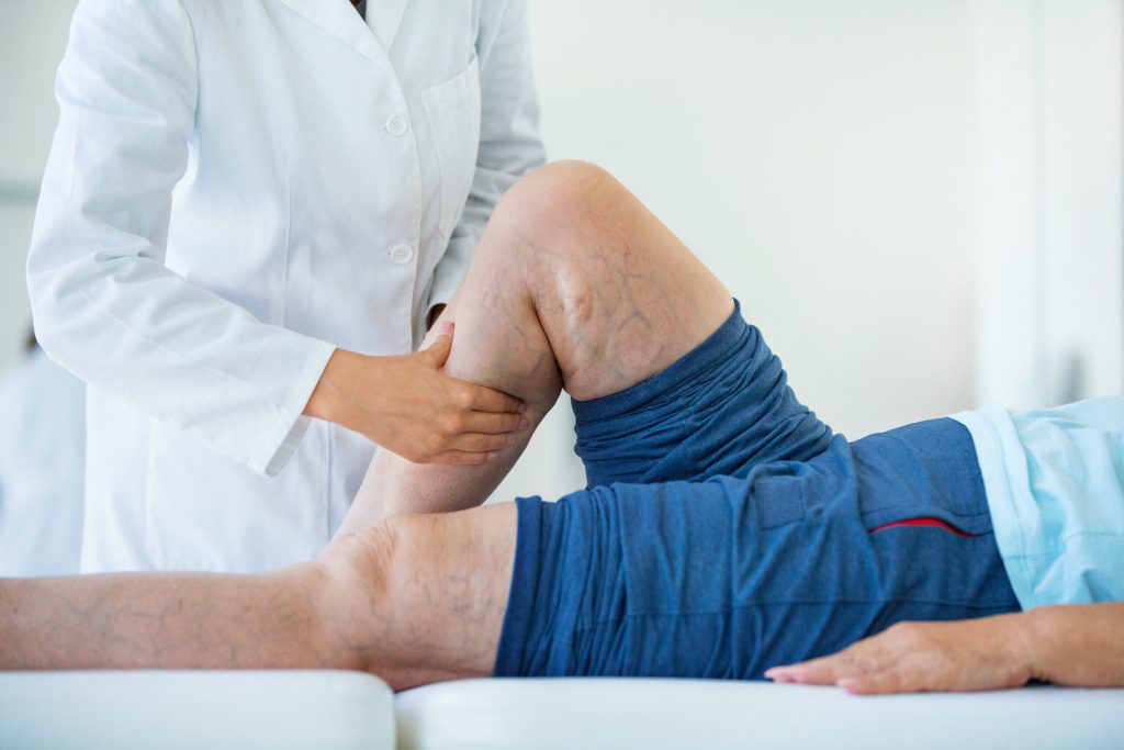 واریس چیست ؟ اهمیت تشخیص و درمان آن